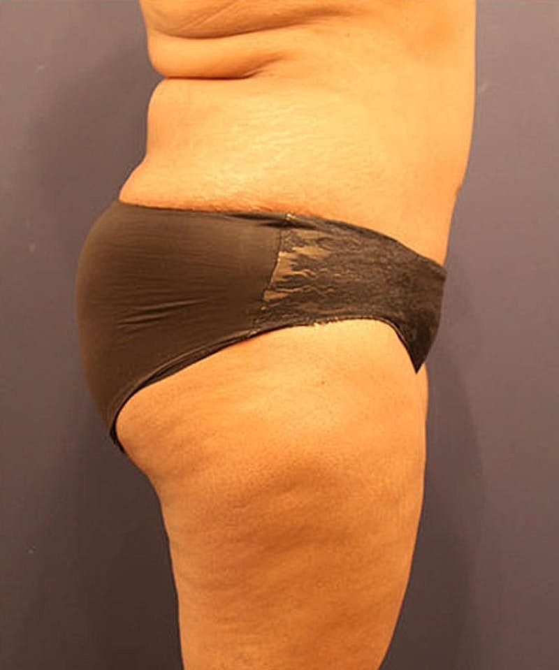 Tummy Tuck Before & After