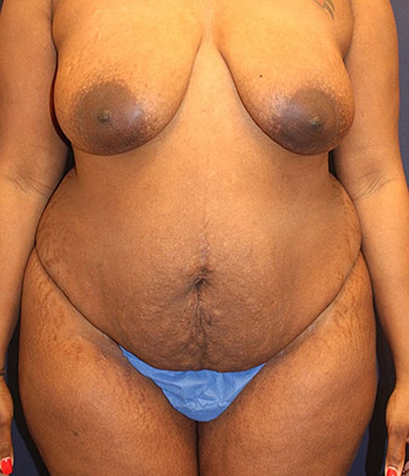 Tummy Tuck Before & After