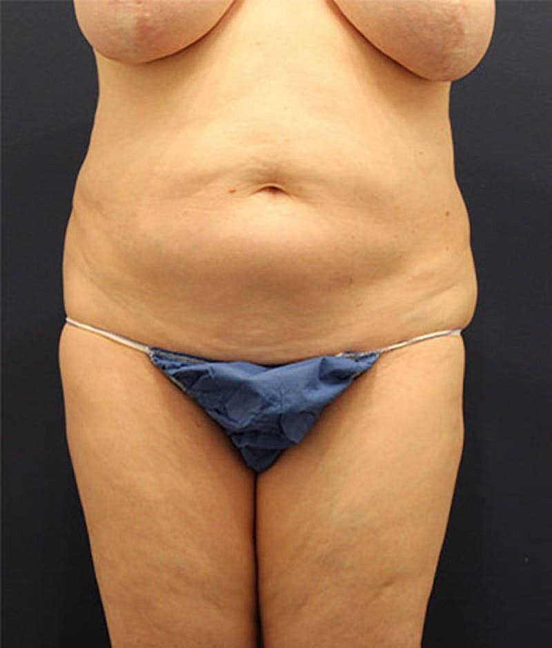 Tummy Tuck Before & After