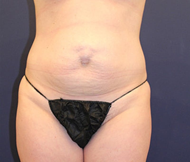 Tummy Tuck Before & After