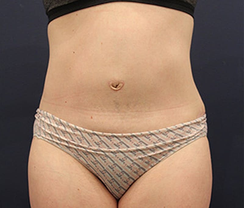 Tummy Tuck Before & After