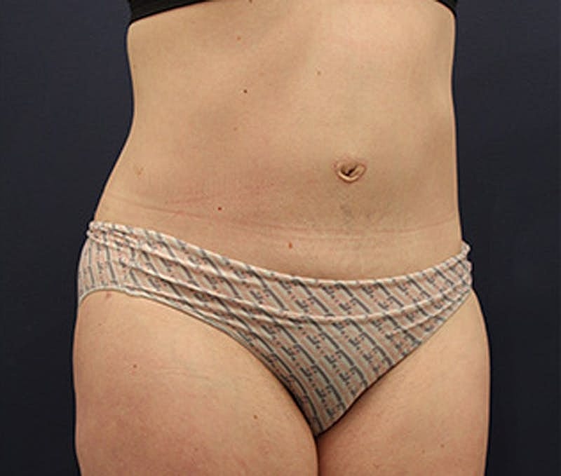 Tummy Tuck Before & After