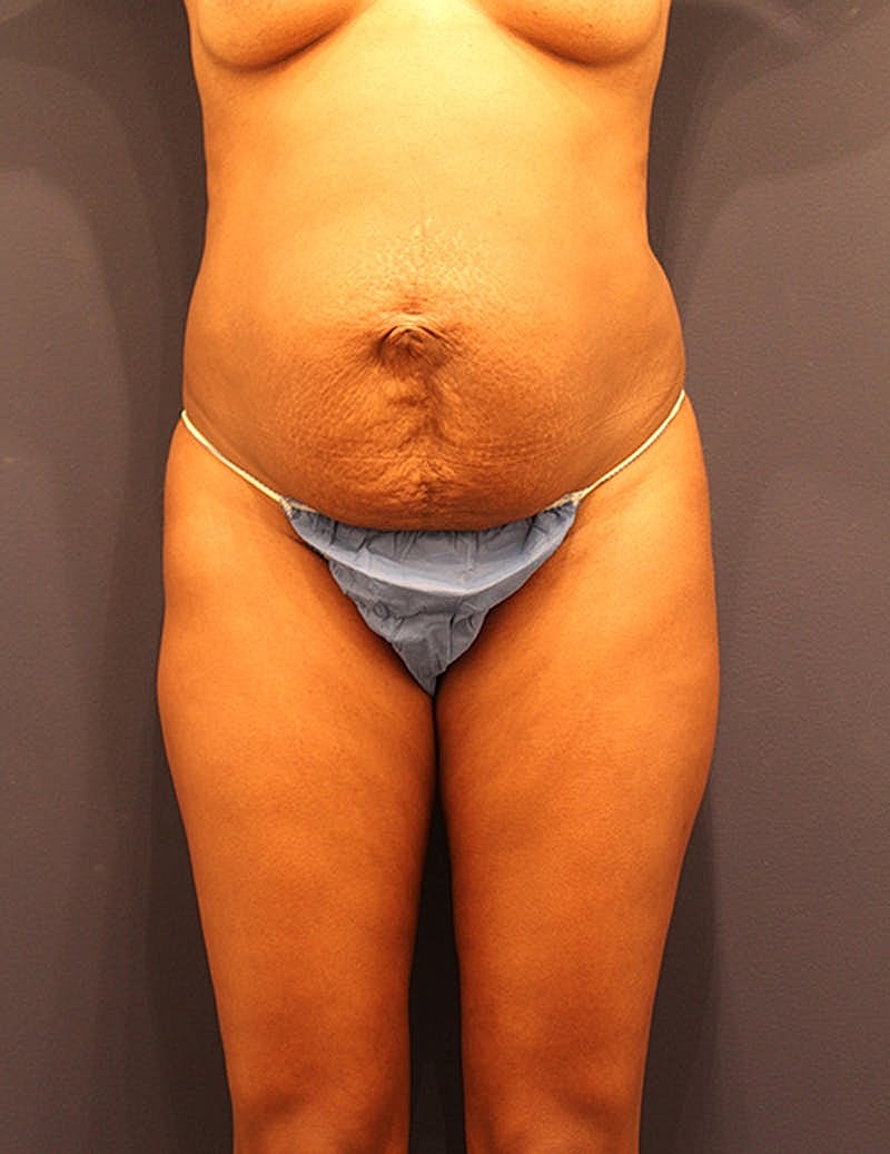 Tummy Tuck Before & After