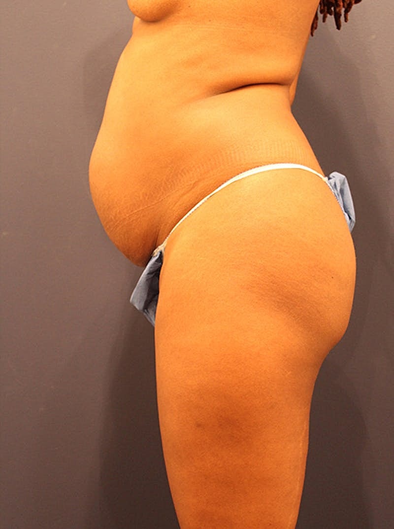 Tummy Tuck Before & After