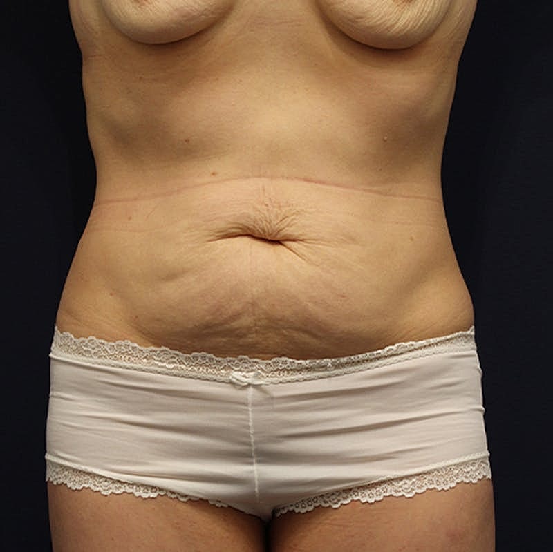 Tummy Tuck Before & After