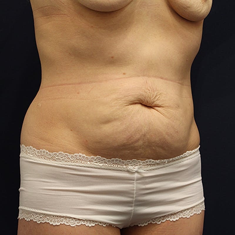 Tummy Tuck Before & After