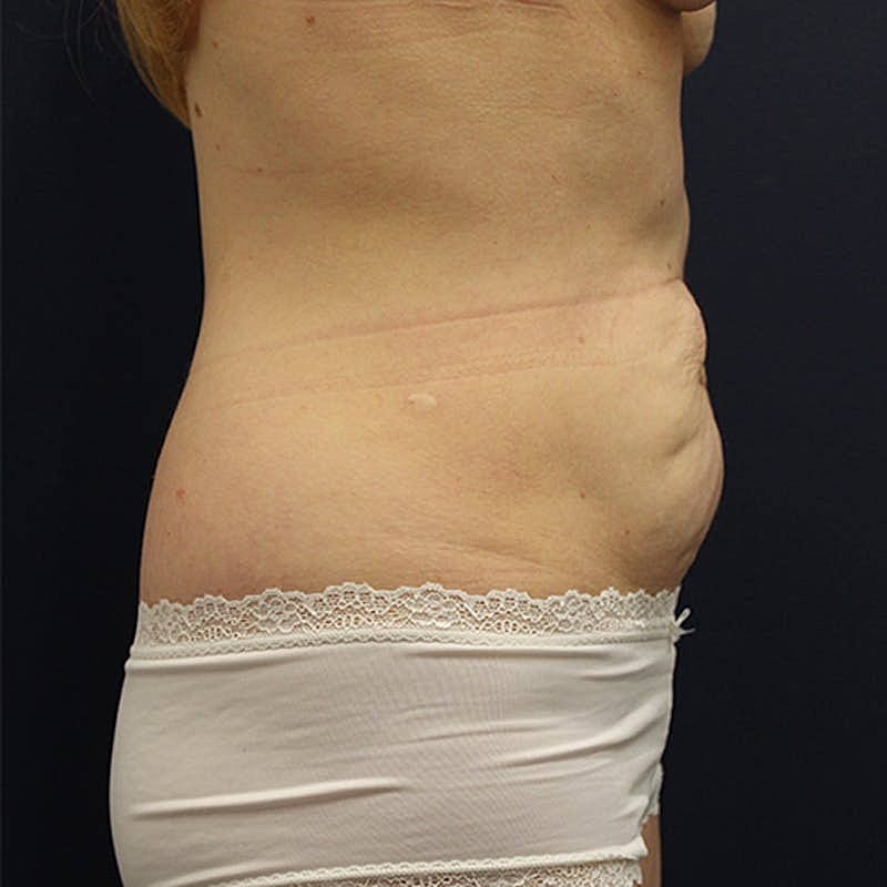 Tummy Tuck Before & After