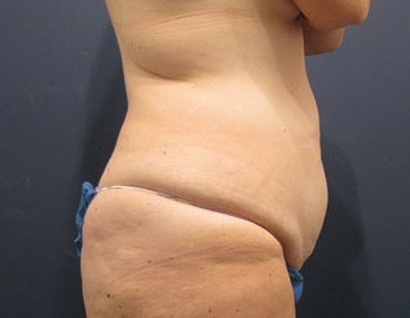 Tummy Tuck Before & After