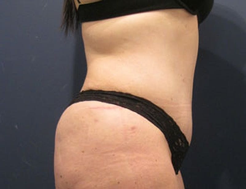 Tummy Tuck Before & After