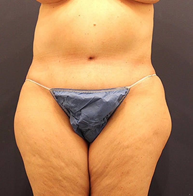 Tummy Tuck Before & After