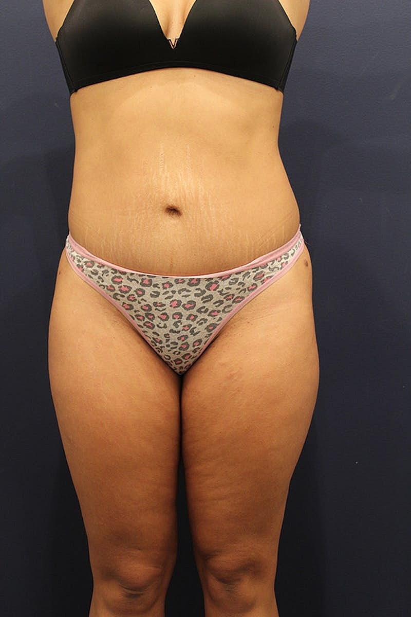 Tummy Tuck Before & After