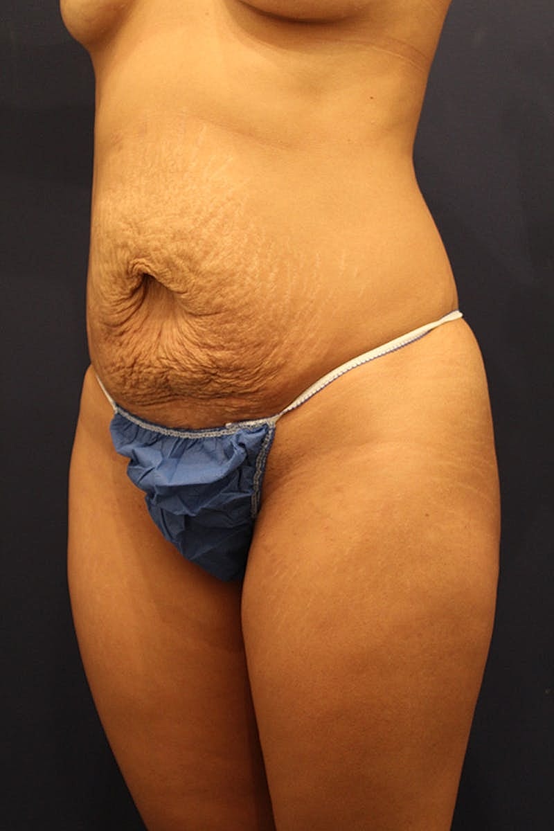 Tummy Tuck Before & After