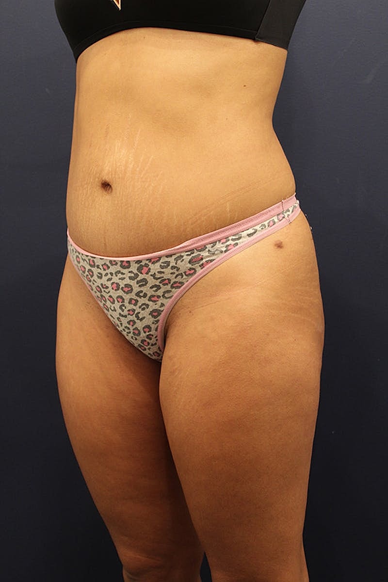 Tummy Tuck Before & After