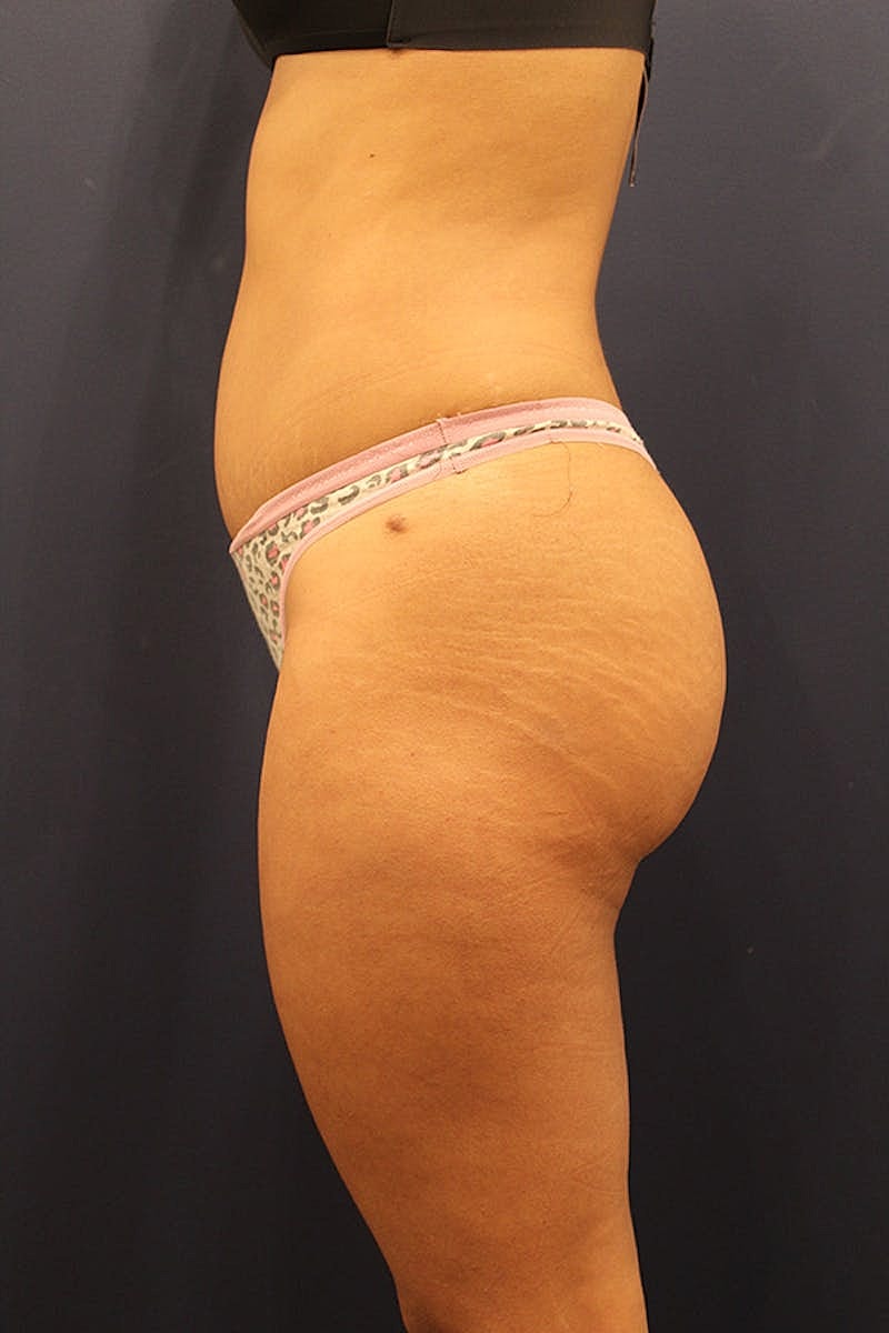 Tummy Tuck Before & After