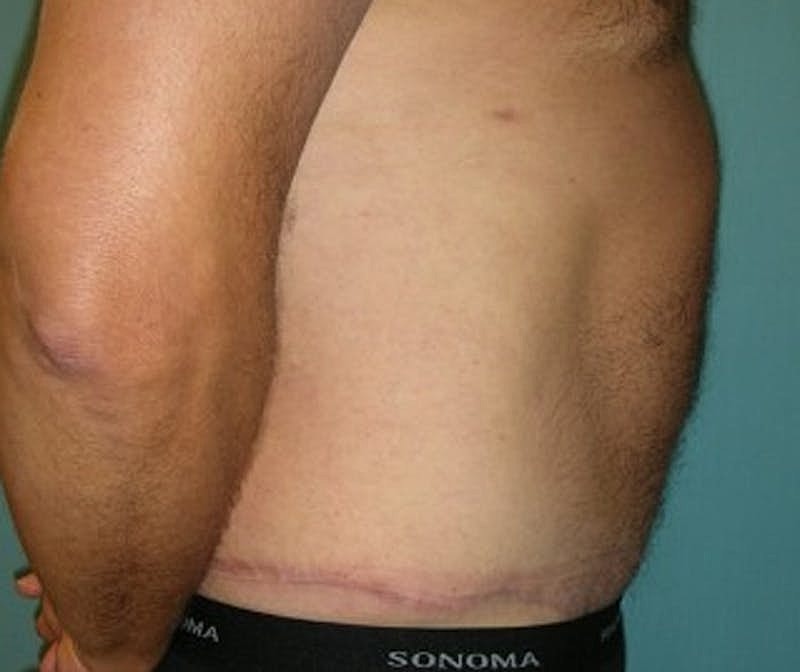 Tummy Tuck Before & After