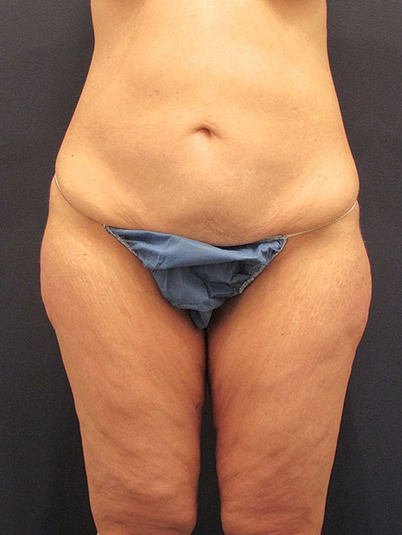 Tummy Tuck Before & After