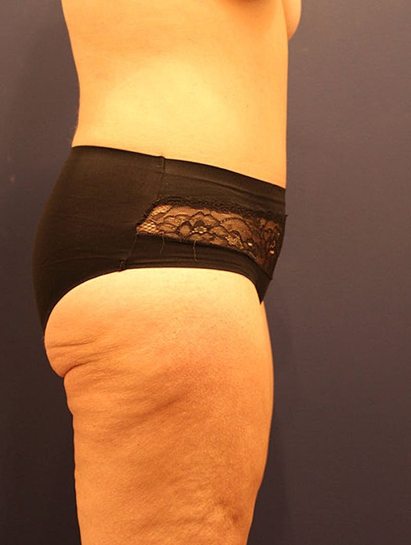Tummy Tuck Before & After