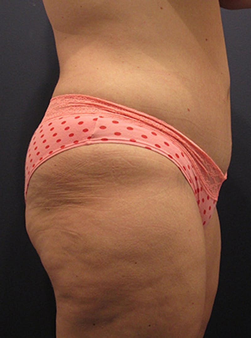 Tummy Tuck Before & After