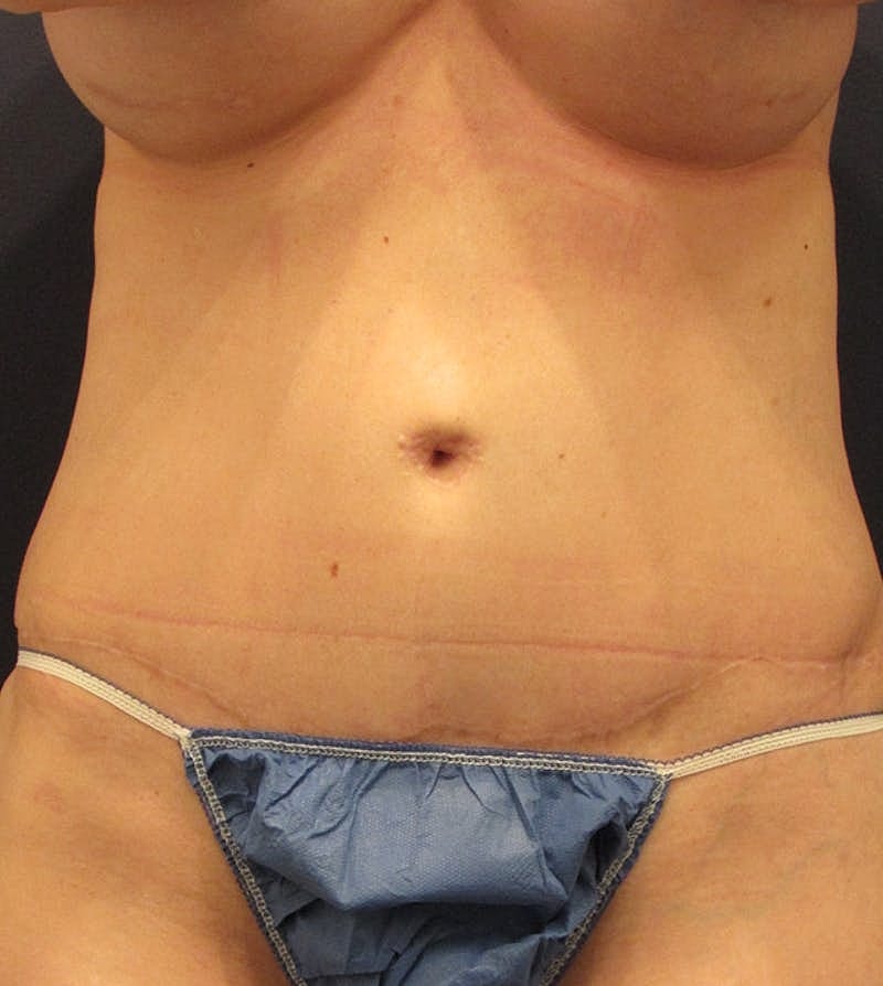 Tummy Tuck Before & After