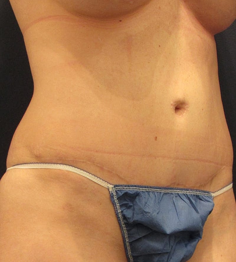 Tummy Tuck Before & After