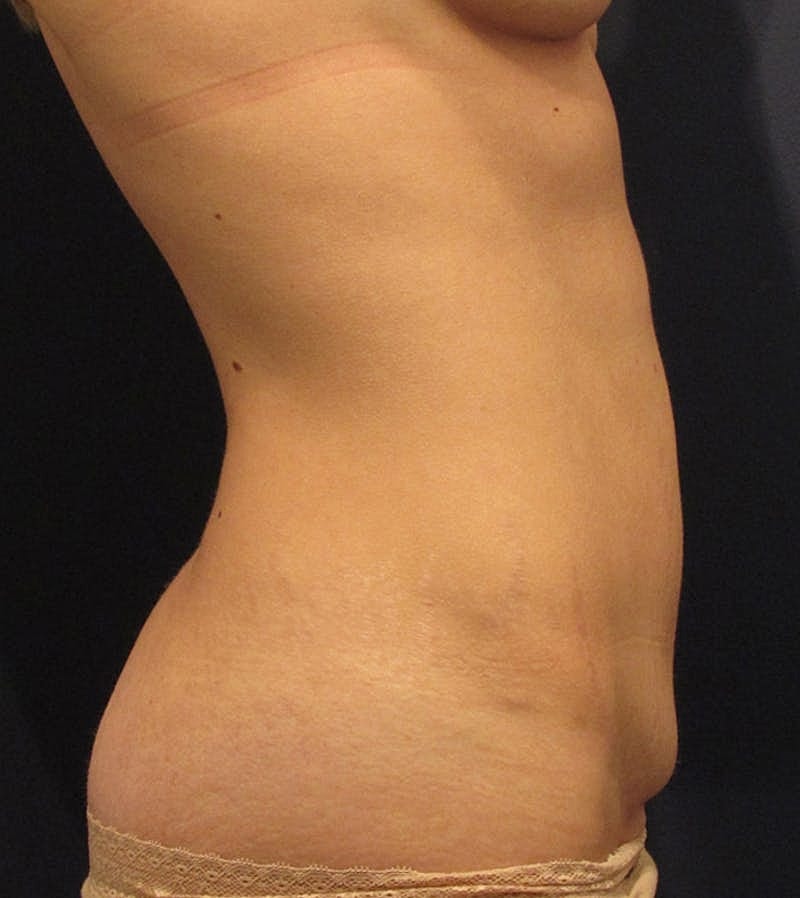 Tummy Tuck Before & After