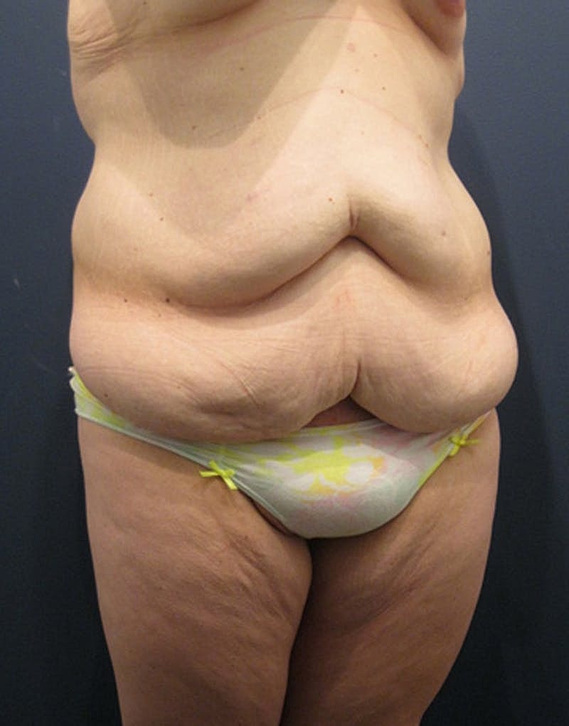 Tummy Tuck Before & After