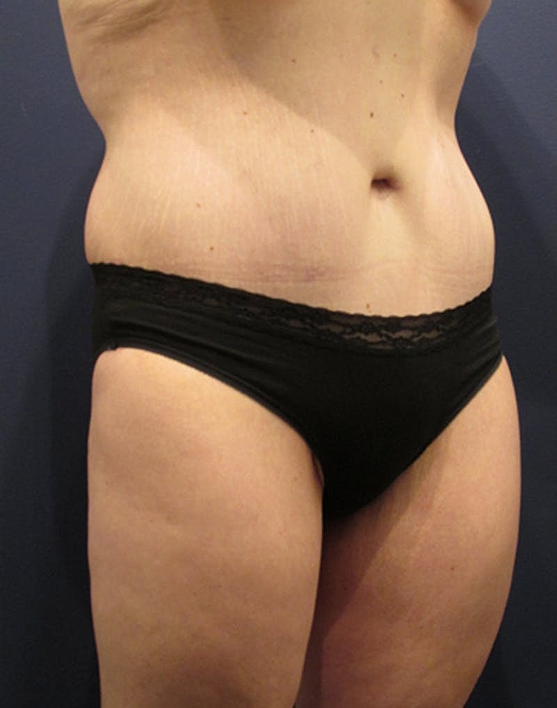 Tummy Tuck Before & After