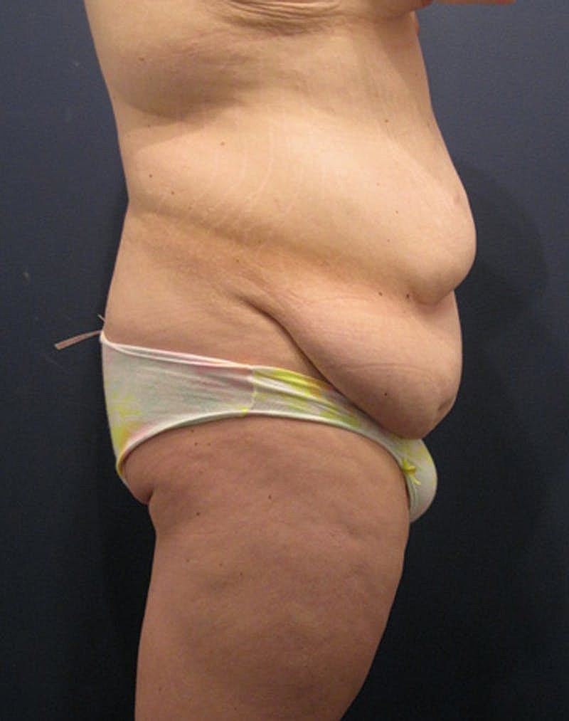 Tummy Tuck Before & After