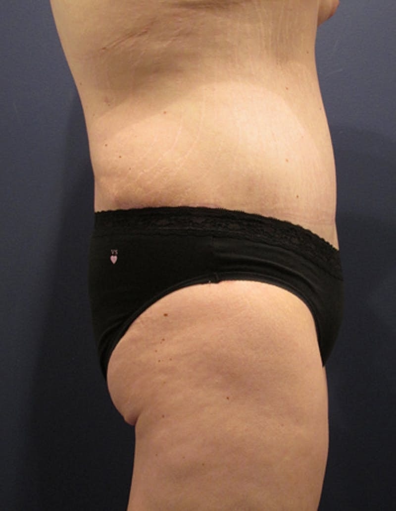 Tummy Tuck Before & After