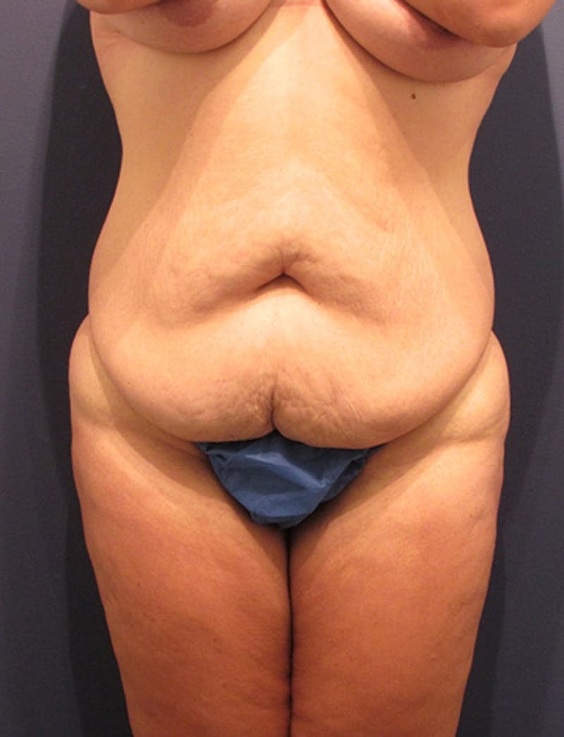 Tummy Tuck Before & After