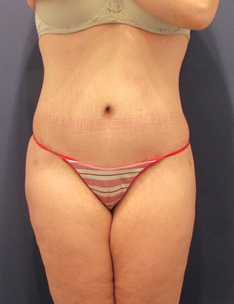 Tummy Tuck Before & After