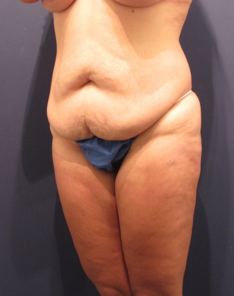Tummy Tuck Before & After