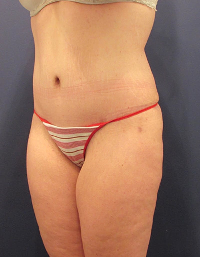 Tummy Tuck Before & After