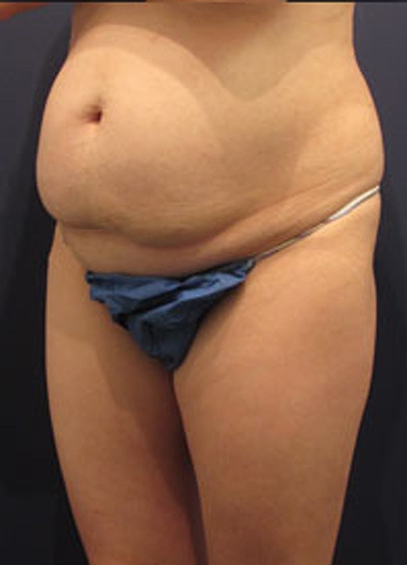 Tummy Tuck Before & After