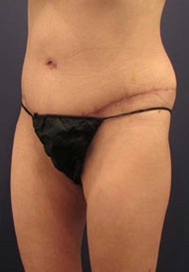 Tummy Tuck Before & After