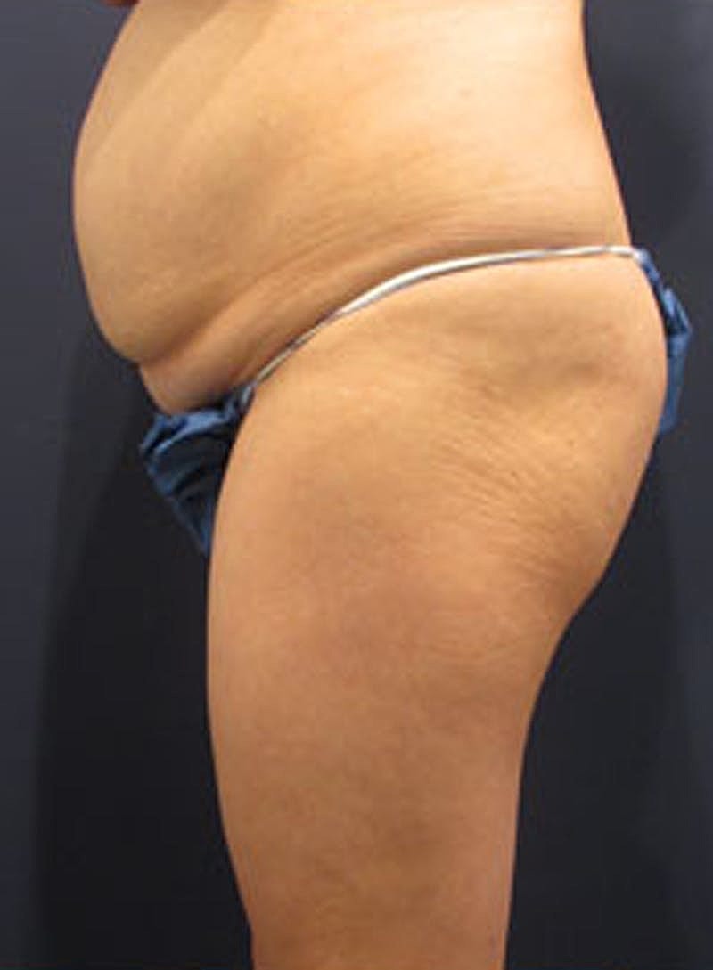 Tummy Tuck Before & After