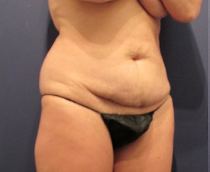Tummy Tuck Before & After