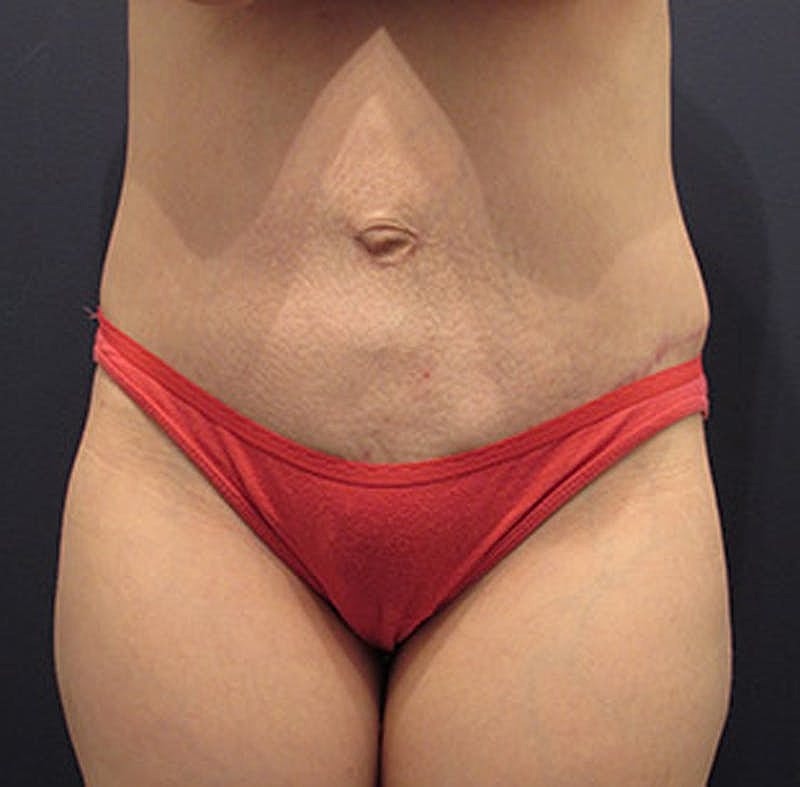 Tummy Tuck Before & After