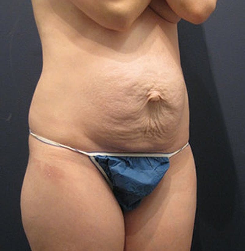 Tummy Tuck Before & After