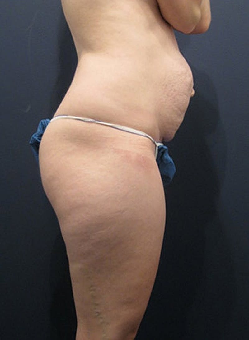 Tummy Tuck Before & After