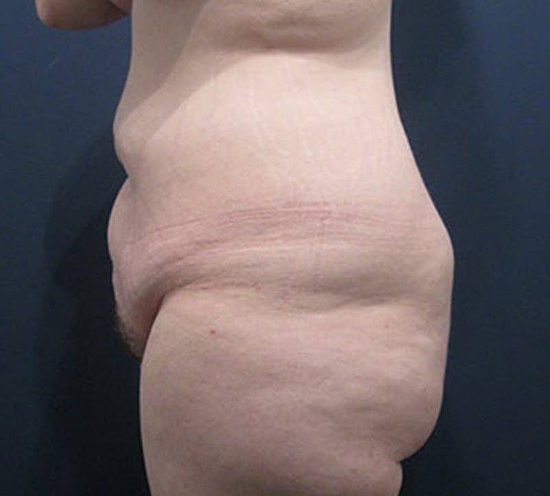 Tummy Tuck Before & After