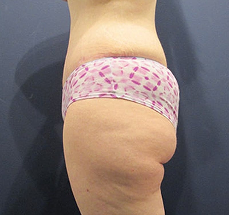 Tummy Tuck Before & After