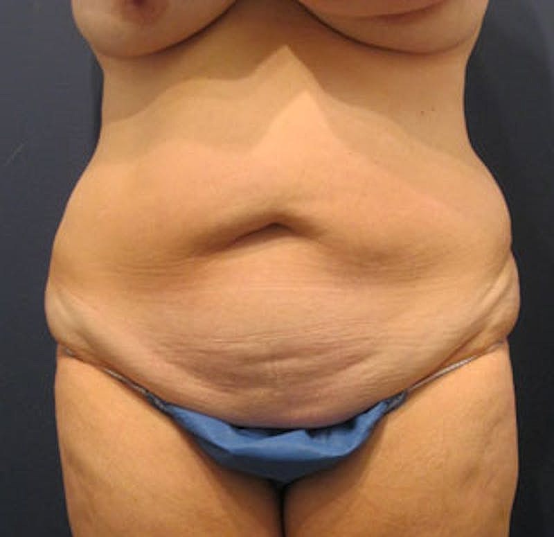 Tummy Tuck Before & After