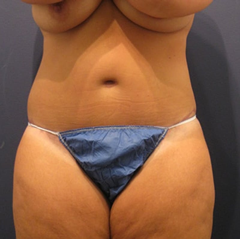 Tummy Tuck Before & After