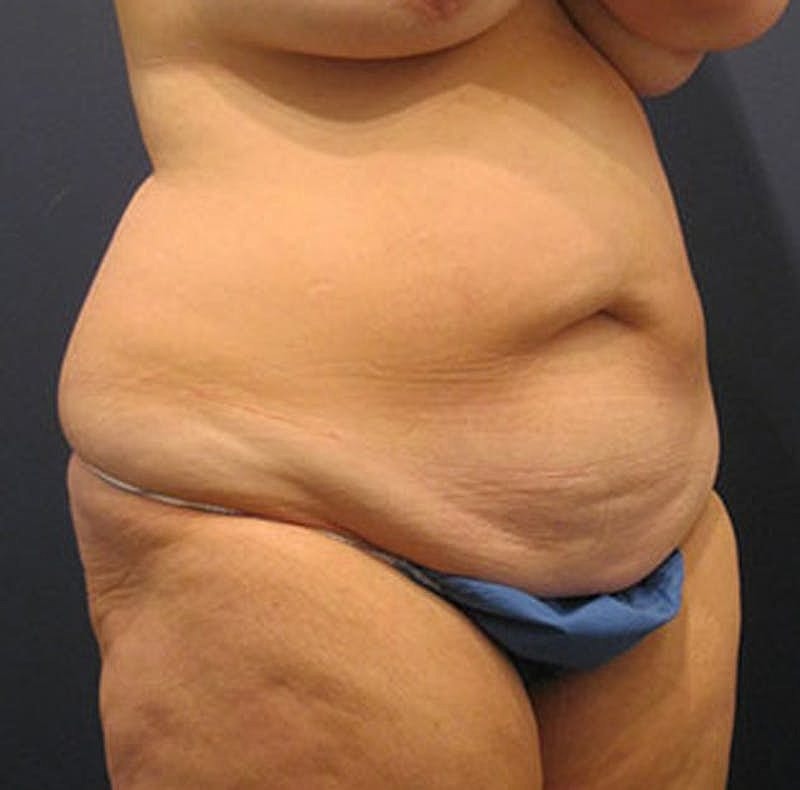 Tummy Tuck Before & After