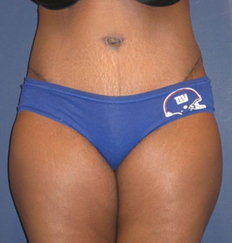 Tummy Tuck Before & After