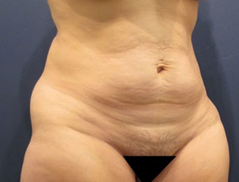 Tummy Tuck Before & After