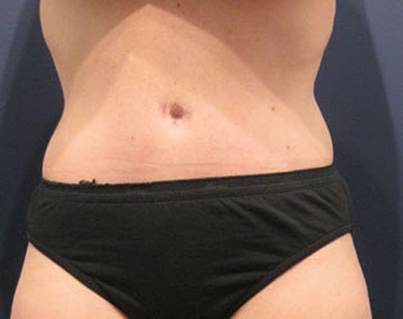 Tummy Tuck Before & After