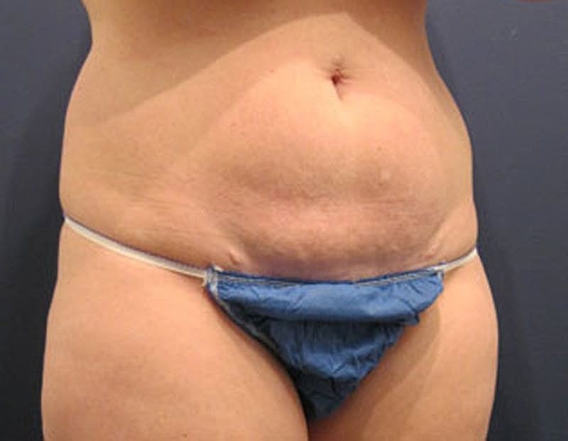 Tummy Tuck Before & After