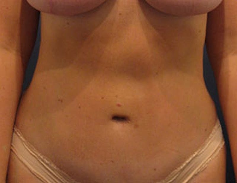 Tummy Tuck Before & After